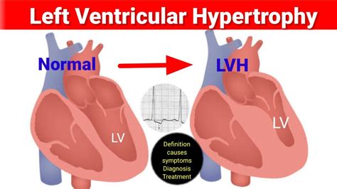 lvh medical abbreviation